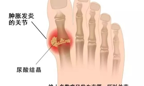 心肌梗死病人心电图动态改变过程-【心肌梗死病人心电图特点】心肌梗死病人心电图特点 - 心肌梗死病人心电图st网